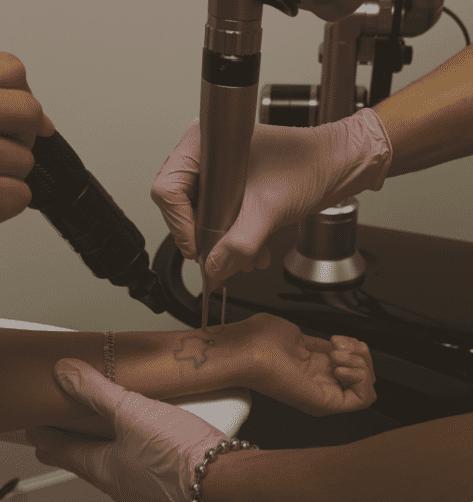 tatto removal